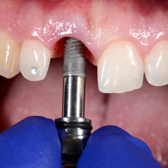 Dental Implants